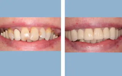 Before and After
